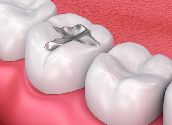 Trám răng chữa sâu răng hiệu quả