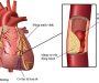 Sự nguy hiểm của bệnh cao huyết áp