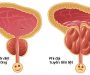 Phì đại tuyến tiền liệt có ảnh hưởng tới chuyện tình dục