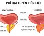 Những điều cần biết về bệnh phì đại tuyến tiền liệt