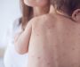 Dấu hiệu khỏi bệnh thủy đậu? bao lâu thì vỡ và lành