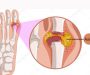 Mách bạn cơ chế và nguyên nhân gây ra bệnh Gout